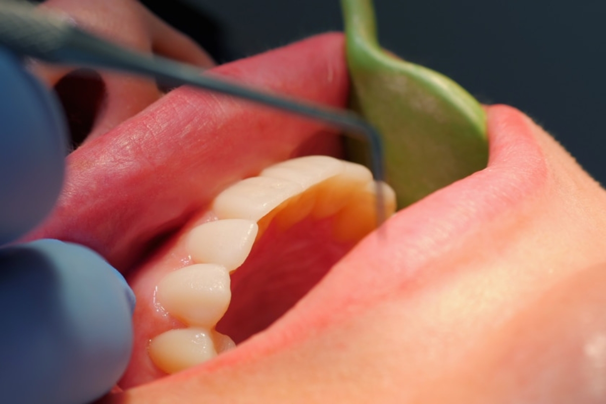 Dental Emergency Machesney Park