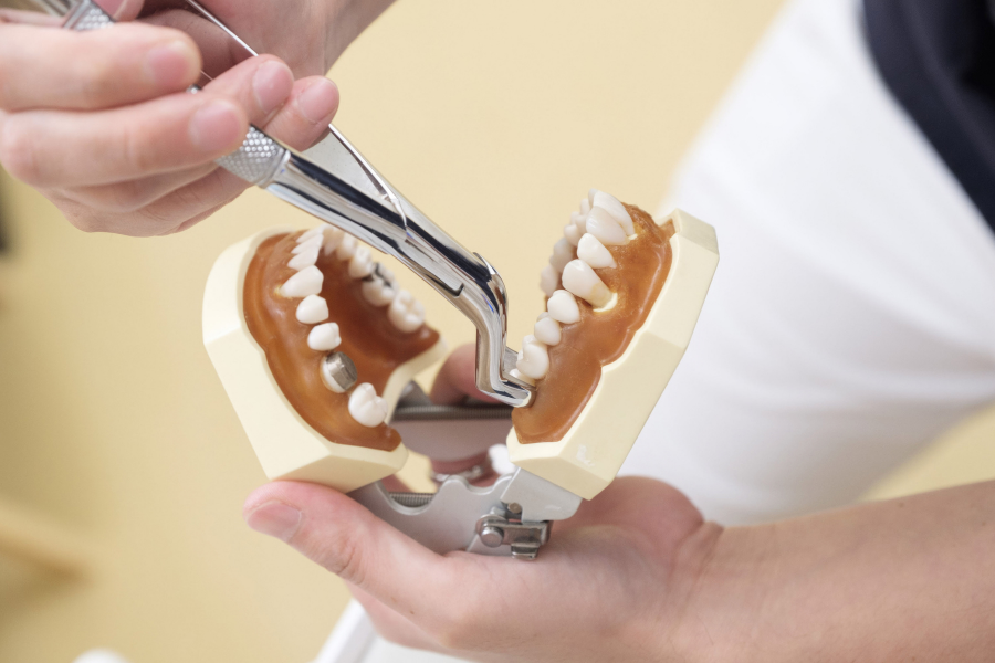 Three Parts of Dental Implants for a Perfect Smile